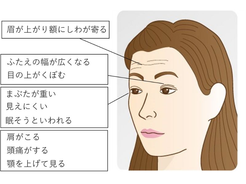 CS眼科-眼瞼下垂