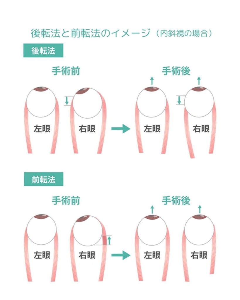 CS眼科クリニック 内斜視治療