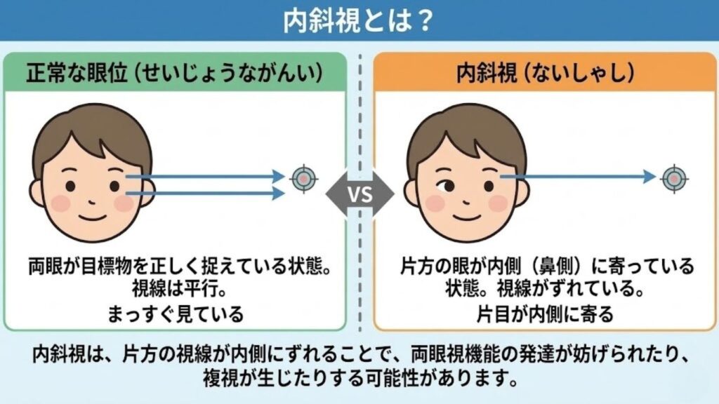 CS眼科クリニック 内斜視治療