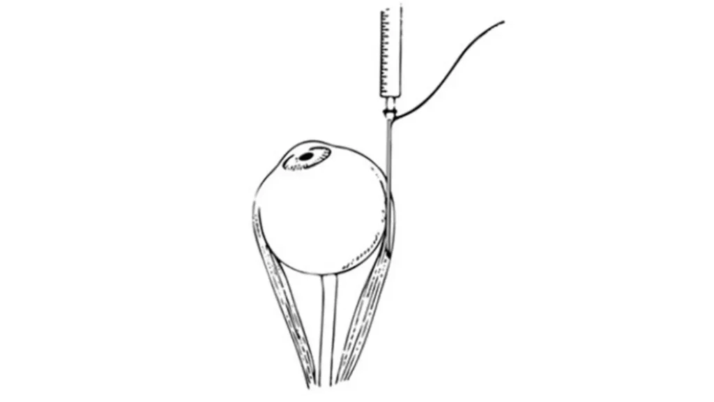 CS眼科クリニック 内斜視治療