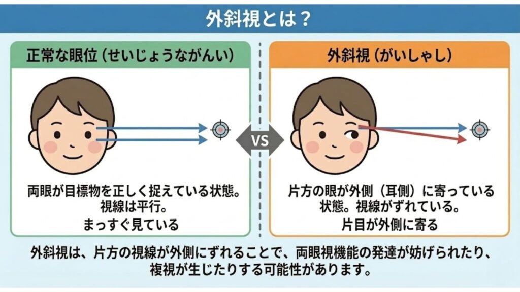 CS眼科クリニック外斜視治療