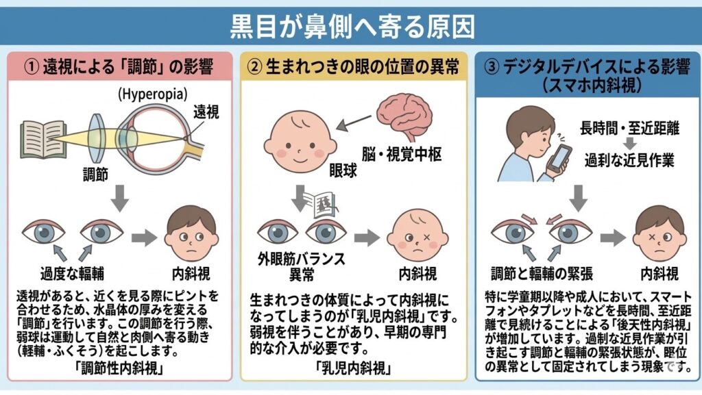 CS眼科クリニック 内斜視治療