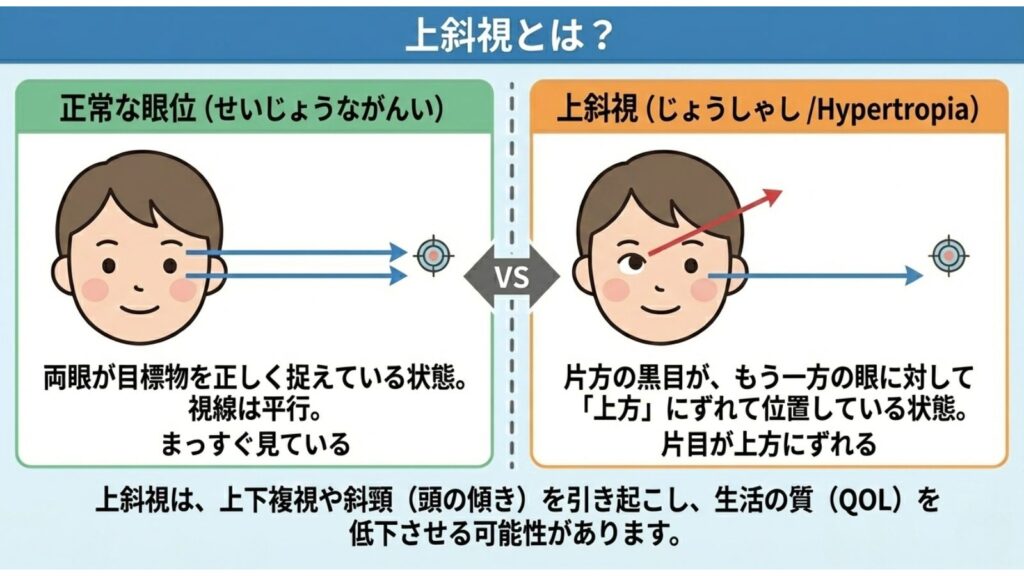 CS眼科クリニック_上斜視治療