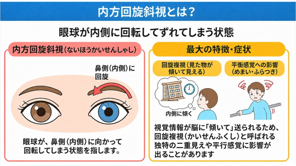 内方回旋斜視とは？